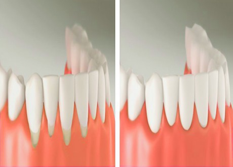 Self Ligating Dental Braces